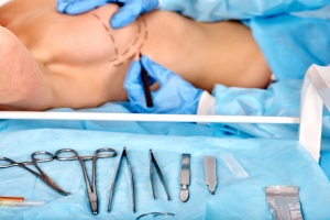 5 mitw o chirurgii plastycznej [Fot. Gennadiy Poznyakov - Fotolia.com]