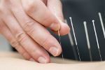 Akupunktura lekiem na przewleky bl plecw [© Max Tactic - Fotolia.com]