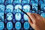 Alzheimer wyniszcza ekspresowo [© Tryfonov - Fotolia.com]