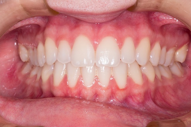 Choroby jamy ustnej mogą nasilać nadciśnienie [fot. alexandreest from Pixabay]