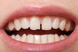 Diastema: tylko defekt kosmetyczny czy ju problem zdrowotny? [Diastema, © Ocskay Bence - Fotolia.com]