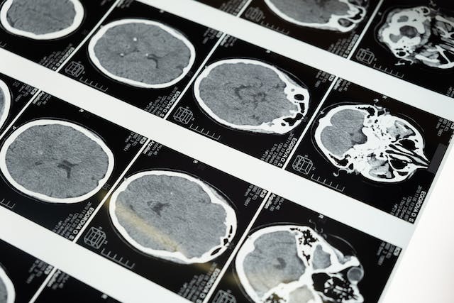 Elektryczna stymulacja mzgu - nadzieja na skuteczn terapi zaburze psychicznych [fot. cottonbro studio, Pexels.com]