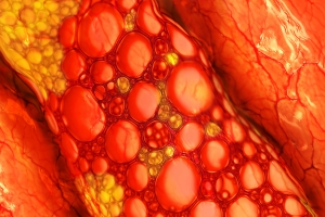 Hipercholesterolemia rodzinna. Wikszo chorych nie wie e choruje [Fot. Giovanni Cancemi - Fotolia.com]