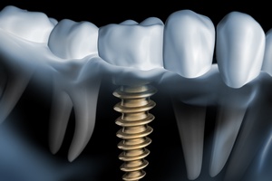 Implanty: "drugie zęby" w dojrzałym wieku [© psdesign1 - Fotolia.com]