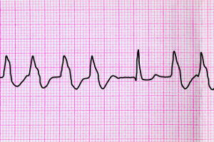 Kiedy diagnoza wymaga czasu: monitorowanie EKG w arytmii [Fot. olga355 - Fotolia.com]