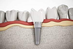 Kompletne uzbienie: implant jak zb naturalny [© destina - Fotolia.com]