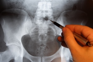 Osteoporoza - odebrana przyszo   [© luxpainter - Fotolia.com]