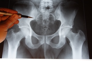 Osteoporoza - podstawowe informacje [© luxpainter - Fotolia.com]