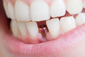 P wieku implantw stomatologicznych [©  AnnaMoskvina - Fotolia.com]