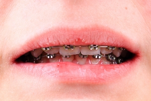Prosty zgryz. 7 mitw zwizanych z leczeniem ortodontycznym [Fot. jonnysek - Fotolia.com]