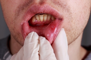 Rak jamy ustnej coraz większym zagrożeniem [Fot. deviddo - Fotolia.com]