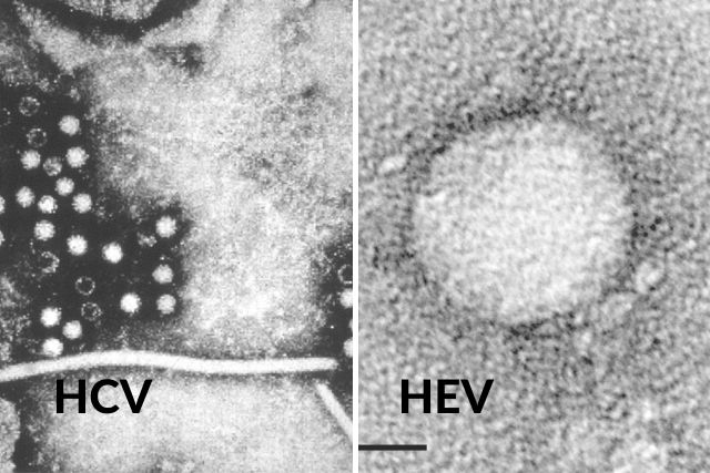 Wirus zapalenia wątroby typu C hamuje wirus typu E [fot. collage Senior.pl / Canva]