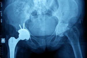Wszczepienie endoprotez: jak powrci do zdrowia po zabiegu [© oceandigital - Fotolia.com]