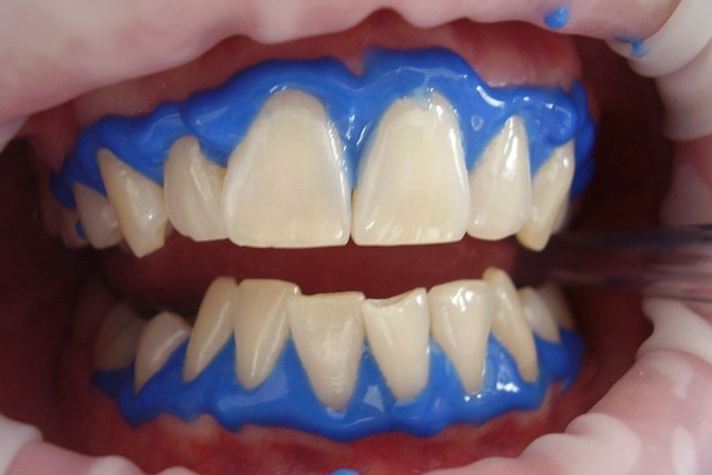 Wybielanie może uszkadzać zęby [fot. karensg80 from Pixabay]