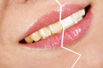 Wybielanie zębów dla każdego [Š karuka - Fotolia.com]
