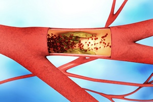 Wysoki cholesterol a rak piersi [© MAN AT MOUSE - Fotolia.com]