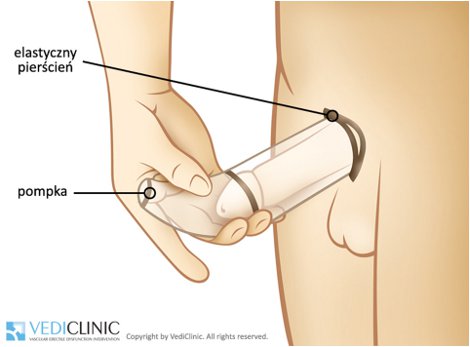pierścionek na sprzężeniu penisa jeśli erekcja nagle zniknie