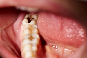 Zdrowie zębów wpływa na zdrowie serca [Fot. kirill4mula - Fotolia.com]